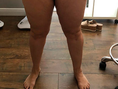 after-legs